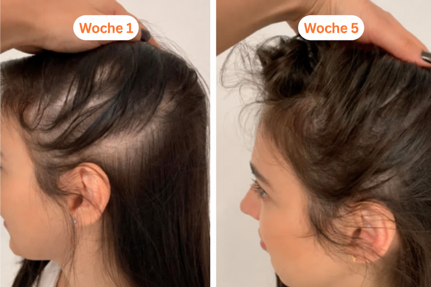 Foto der Haarentwicklung